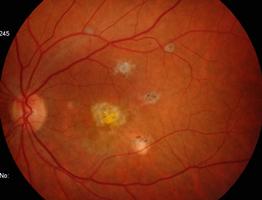 OROIIT MULTIOL Síndrome que associa manchas esbranquiçadas no fundo ocular,
