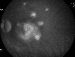 Oe Lesões efeito janela (hiperfluorescentes) correspondentes às cicatrizes coriorretinianas. Lesão hiperfluorescente, que aumenta de intensidade e com bordos fluos, indicativo duma lesão activa. S.