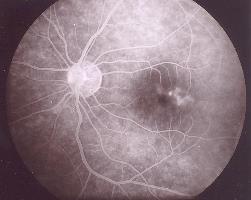 retina periférica surge isquémica, o que é um elemento de mau prognóstico.
