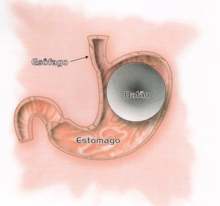 Banda Gástrica consiste na colocação de uma prótese de silicone em forma de banda ou fita em volta da parte proximal (de cima) do estômago, de modo a causar um estreitamento no estômago e criar um
