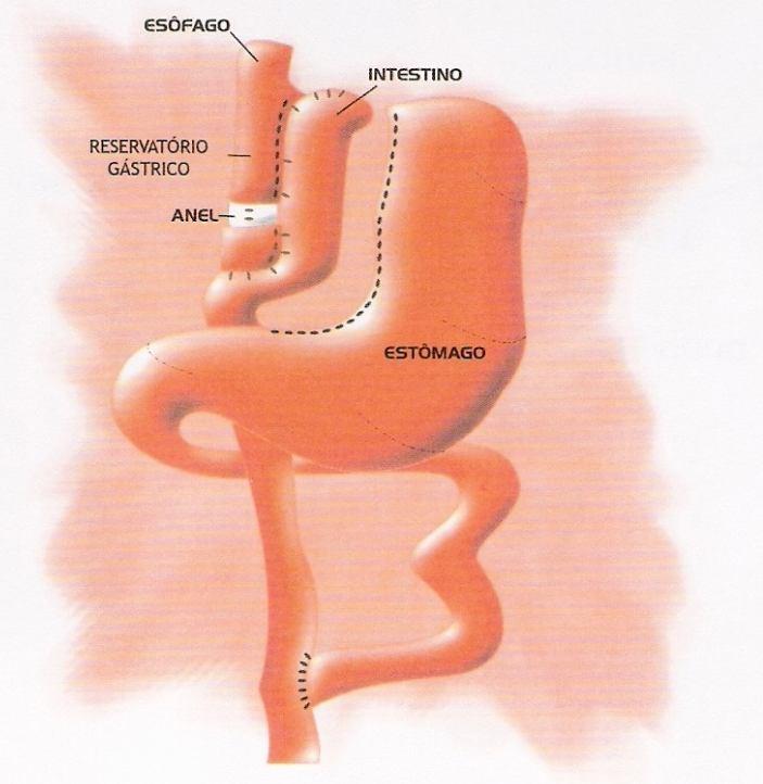 Gastroplastia com Derivação Intestinal (Operação de Capella; Operação de Fobi; Operação de Wittgrove) Estas 3 técnicas diferem em apenas alguns detalhes.