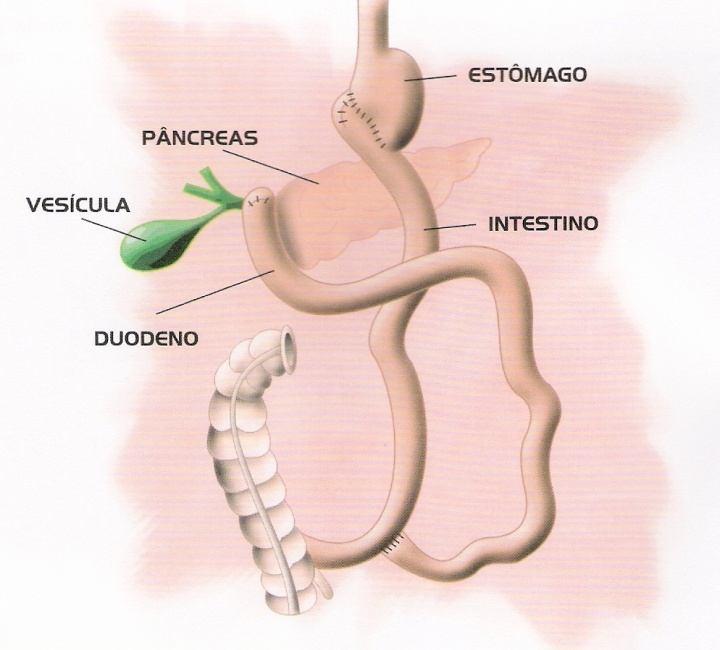 Por ser um procedimento tecnicamente mais complexo, podem ocorrer várias complicações no pós-operatório imediato, como infecção, hérnia e fístula.