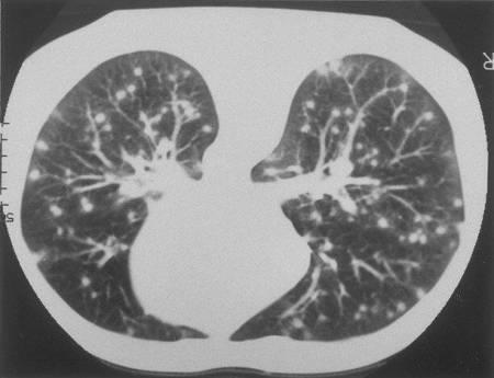 Micoses sistêmicas Histoplasmose Causador: Histoplasma capsulatum; Áreas com solo rico em nitrogênio (áreas contaminadas com fezes de morcegos e