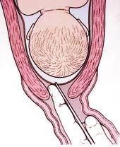 AMNIOTOMIA (ruptura da bolsa