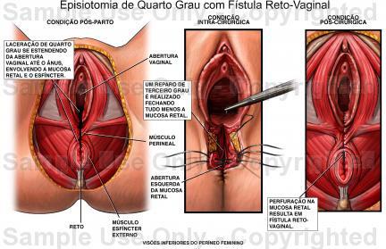 Lacerações perineal:.