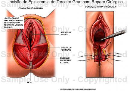 vaginal/perineal perineal,,