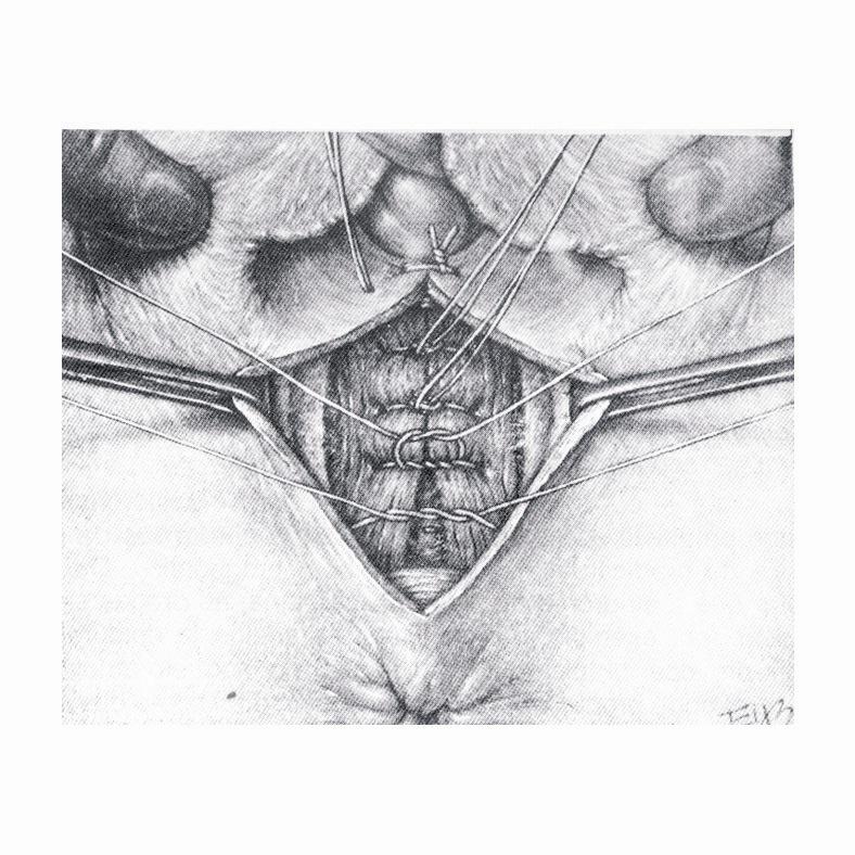 Pontos cirúrgicos utilizados: -Mucosa vaginal = contínuo ancorado