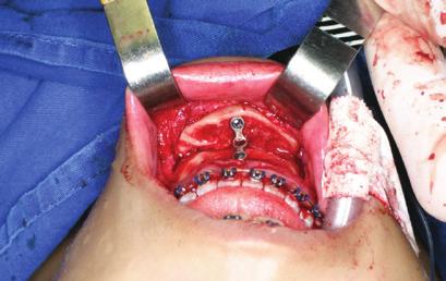 Avaliação de déficit neurossensorial em pacientes com síndromes craniofaciais submetidos a avanço horizontal do mento de síndromes craniofaciais submetidos a avanço horizontal do mento.