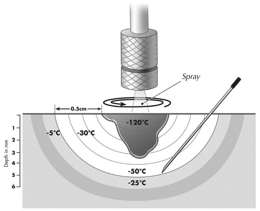 38 Figura 8: Esquema representando a agulha do termopar inserida em local próximo à lesão e mensuração da temperatura. Fonte: GRAHAM e BARHAM, 2003.