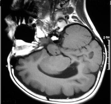 A RM de encéfalo mostrou paquigiria bilateral (Figura 2). O EEG evidenciou desorganização da atividade de base, descargas epileptiformes multifocais e FE (Figura 3).