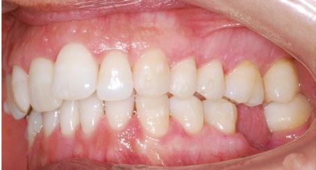 15.  Invisalign.