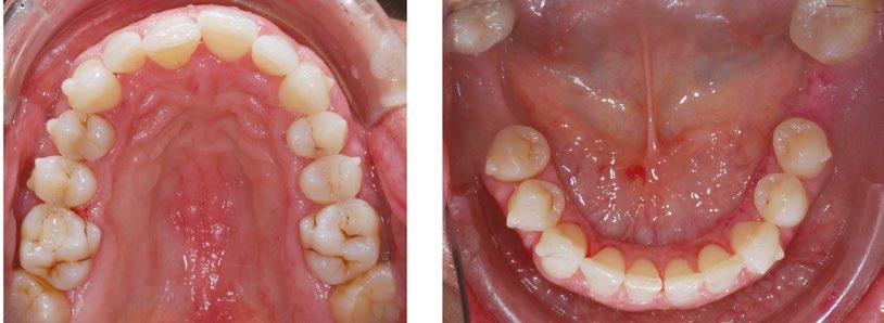 Invisalign com alinhadores.