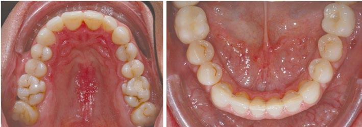 impedir procedimentos completos de higiene oral e causar agregação bacteriana.