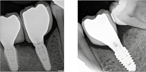 Fig. 27. RX dos implantes (AnyRidge, Megagen ) colocados na zona posterior do maxilar inferior, correspondente aos dentes 37, 46, e 47.