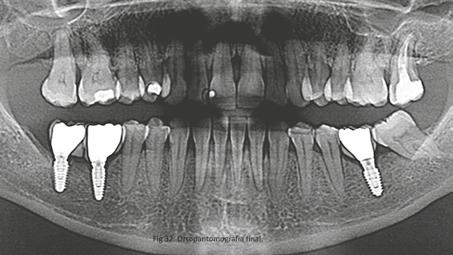 Este tipo de movimentos uniformes previnem que a placa supragengival migre subgengivalmente e destrua o tecido periodontal (Lu et al., 2018).