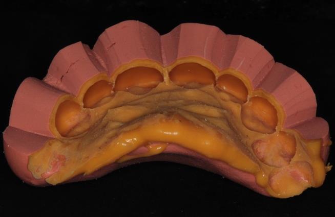 14 O planejamento foi exposto à paciente, através da realização de um Mock-up, e, após concordância da mesma, foi marcada a cirurgia periodontal.