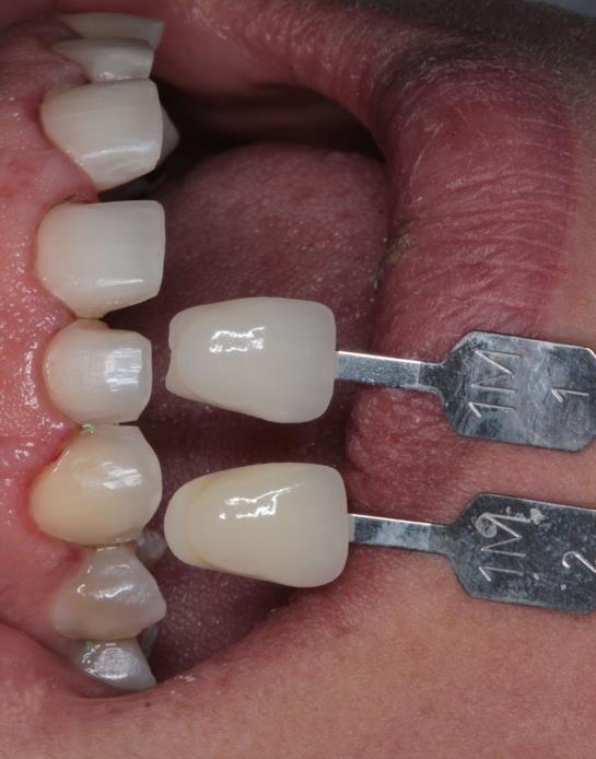 Ambos os moldes foram descontaminados com solução de hipoclorito, sendo o inferior vazado com gesso tipo IV (Durone IV Dentsply) e o superior enviado para ser vazado no