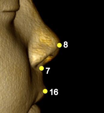 direita: formada pelos pontos mais lateral (Cne d) e medial (Cni d) da cavidade nasal; 11 e 12- Cavidade nasal equerda: formada pelos pontos mais lateral (Cne e) e medial (Cni e) da cavidade nasal;