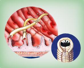 Sintomas - O sangramento causado pelos dentes do ancilóstomo provoca anemia.