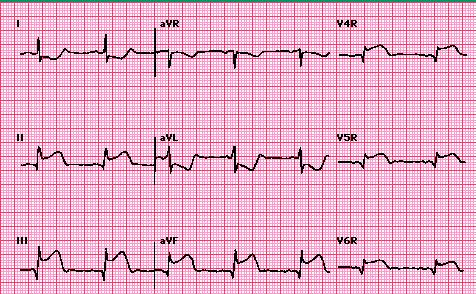 INFARTO