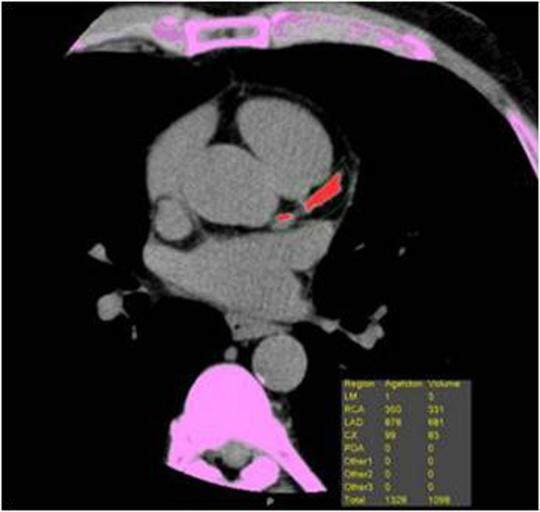 2 Análise da angiografia coronária pela TCMD As imagens adquiridas com cortes axiais de 0,5 mm de espessura foram reconstruídas de maneira retrospectiva com interpolação de 0,3 mm pelo método