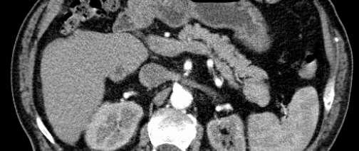 Intrapancreáticos - 0,2% (Mortelé