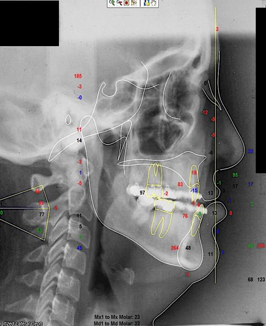 4 Material e Métodos 47 Figura 4 - Demarcação dos pontos cefalométricos no software Dolphin Imaging 4.