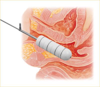 Radioterapia intracavitária