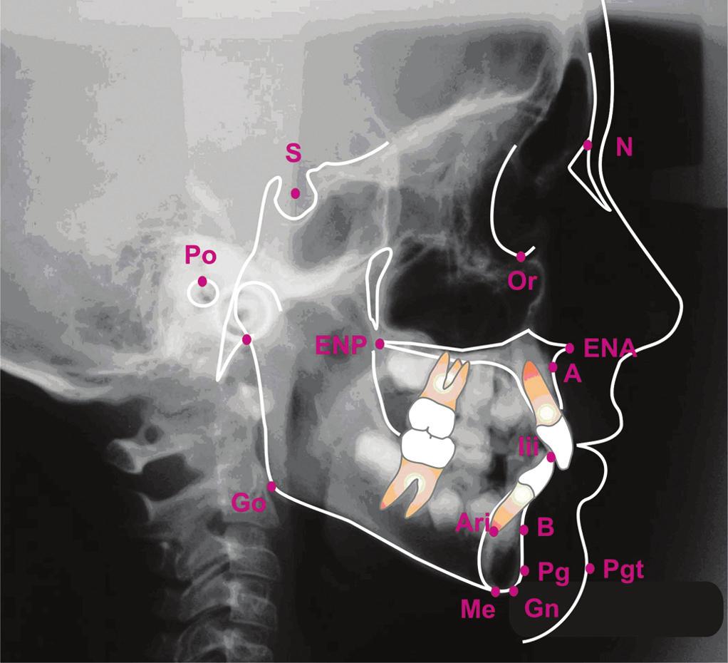 Figura 1. Pontos cefalométricos Figura 2.