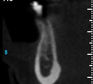 distantes de 1mm, 3mm e 5mm da crista óssea vestibular. Observe as imagens pré-colocação (figura 5.2A) e pós-colocação do implante (Figura 5.2B).