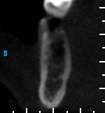 Observe as imagens pré-colocação (figura 5.3A) e póscolocação do implante (Figura 5.3B).