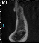 5B: Imagem representativa da influência moderada do artefato no corte, que envolve o dente, posicionado a 2mm do implante.