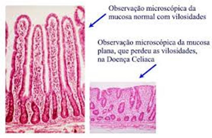 próinflamatórias Ativação de fibroblastos Gliadina deaminada Célula apresentadora de antígeno Apresentação