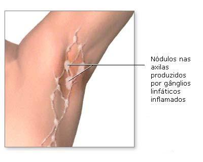 edema/ dor/ fraqueza/parestesia dos membros superiores, intercoslalgia, neuralgia do nervo