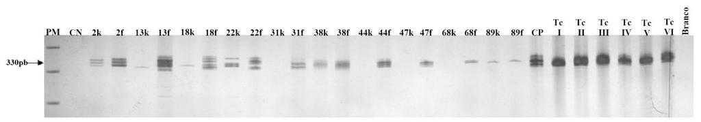 Figura 1 - Gel de poliacrilamida a 6% revelado pela prata representativo das amostras dos pacientes com a forma cardíaca mostrando a amplificação pela PCR do fragmento específico para o T.