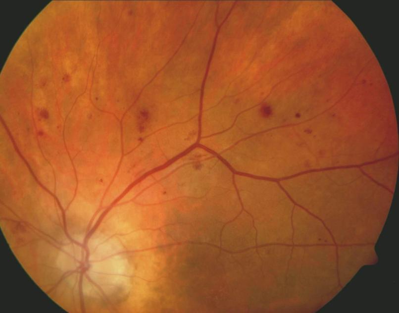 Introdução Uma das patologias mais recorrentes da retina é a RD (Figura 1.3), que é uma manifestação ocular de diabetes Mellitus (DM).