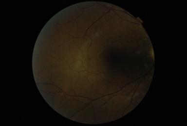Um dos problemas é a necessidade de garantir uma qualidade mínima das imagens da retina de forma que, o método de deteção automática de patologias seja fidedigno. Na Figura 1.