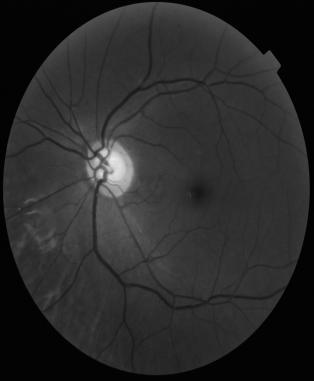 11 (c) o canal verde é o que apresenta o melhor contraste das estruturas anatómicas da retina (Hipwell et al. 2000). Pela Figura 3.