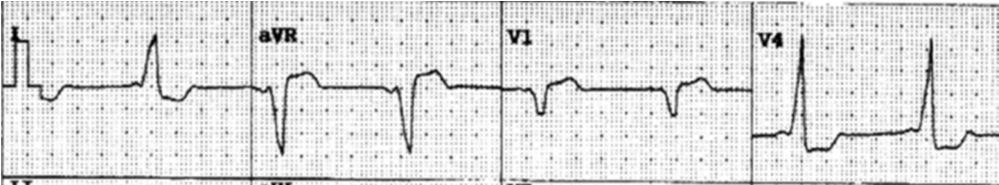 46. Em um paciente com insuficiência cardíaca, a situação em que a digoxina está adequadamente indicada é: a miocardiopatia dilatada com fibrilação atrial b micocardiopatia