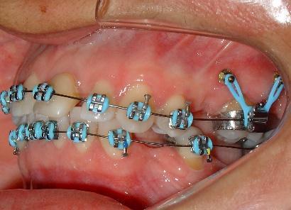 molares superiores (Figura 05). Ao mesmo tempo foram instalados braquetes pré-ajustados, prescrição Roth, slot 0.022 x 0.