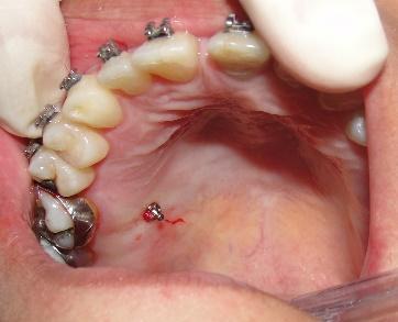 No mês subsequente foi removida a barra transpalatina do tratamento, por motivo do insucesso na mecânica,e foi instalado um