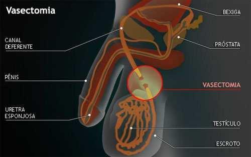 Vasectomia (Deferenctomia) É a secção do canal deferente, sendo a bilateral utilizada como