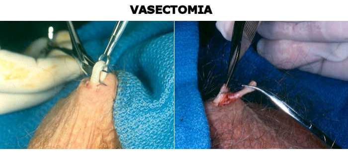 Vasectomia