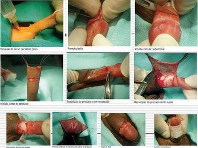 Postectomia (fimose) Histerectomia Remoção cirúrgica
