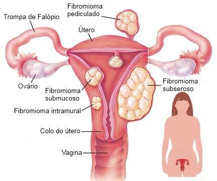 Histerectomia Indicações: nos casos de tumores benignos ou malignos do útero.
