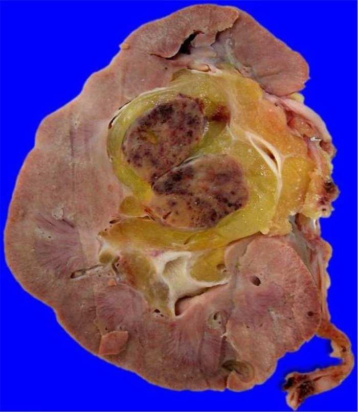Cirurgias Urológicas Nefrectomia Indicações: hidronefrose, tumores renais, cálculos