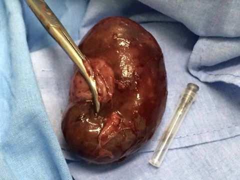 Cirurgias Urológicas Nefrectomia Pré operatório: Observar e anotar volume e aspecto da