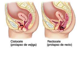 Colpoperineoplastia Indicações: cistocele(deslocamento da bexiga através do orifício vaginal) retocele (protusão do reto na parede posterior vaginal).