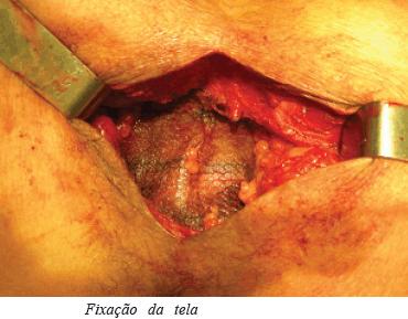 Colpoperineoplastia Pós operatório: Observar e anotar sangramentos na região perineal.