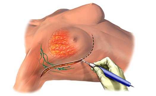 Mastectomia É a remoção parcial ou total da